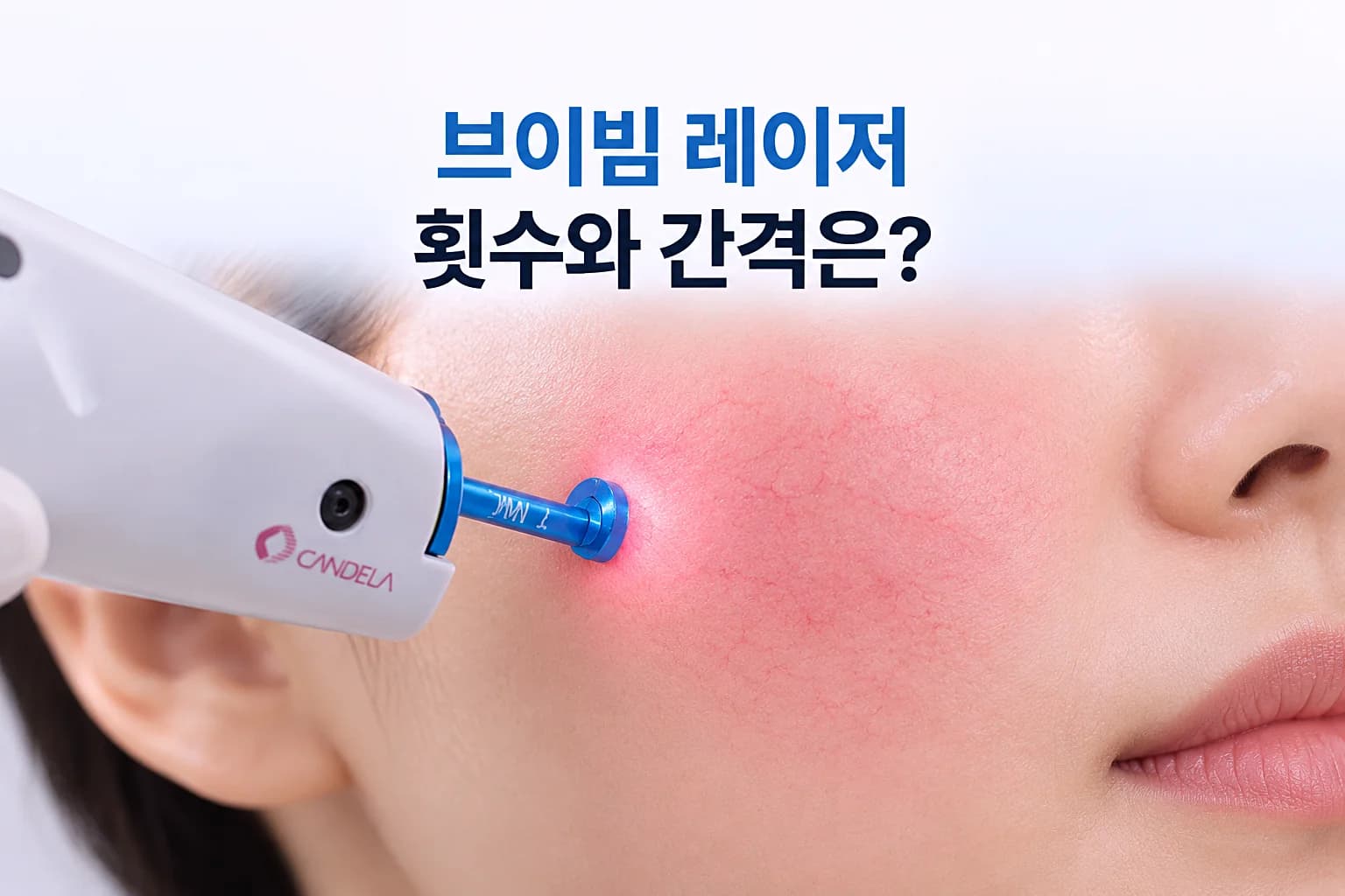 브이빔 레이저 핸드피스가 붉은기 있는 볼 피부에 닿는 장면을 담은 횟수와 간격 안내 썸네일